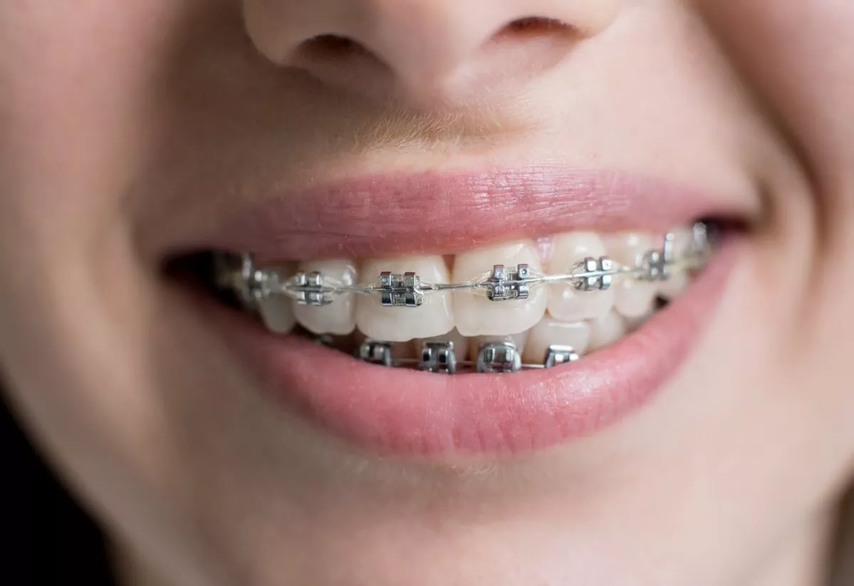 close-up-shot-teeth-with-braces-smiling-female-patient-with-metal-brackets-dental-office-orthodontic-treatment